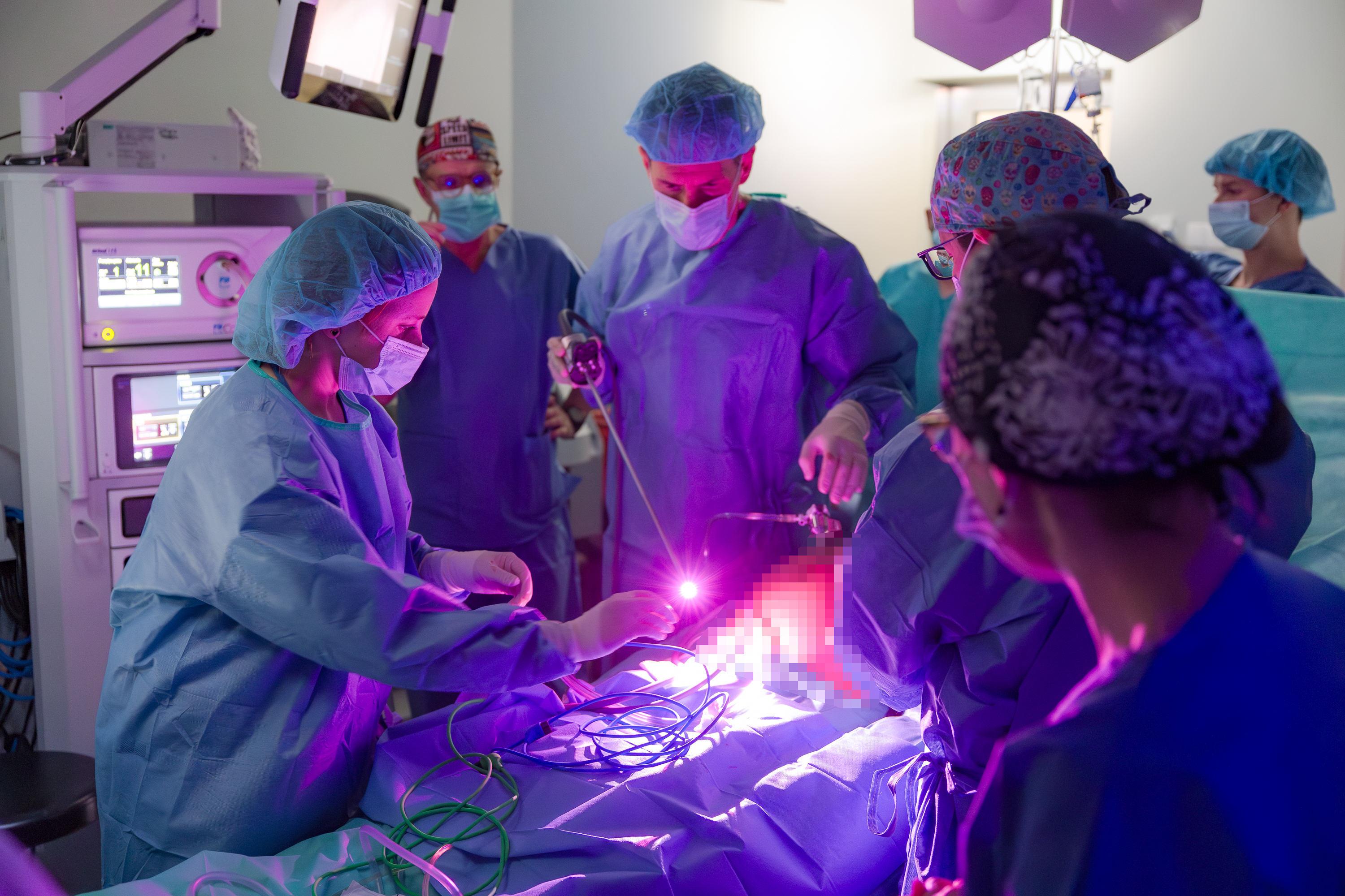 Zdjęcie przedstawia scenę z sali operacyjnej. W centrum kadru znajduje się stół operacyjny przykryty niebieską tkaniną, nad którym pochyla się czterech pracowników medycznych w niebieskich fartuchach i czepkach. Dwie osoby po lewej stronie, w tym kobieta na pierwszym planie, trzymają narzędzia operacyjne.  Główny punkt zainteresowania jest oświetlony jasnym, fioletowo-różowym światłem, częściowo zasłaniając dokładny widok operowanego obszaru. W tle, po lewej stronie, widoczny jest pionowy panel monitorujący ze świecącymi wskaźnikami. Pozostałe dwie osoby stoją za stołem, obserwując przebieg operacji. Jest to dynamiczna scena pracy zespołowej w warunkach szpitalnych.